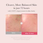 Medicube TXA Niacinamide serum with tranexamic acid for dark spots post acne marks and brighter skin
